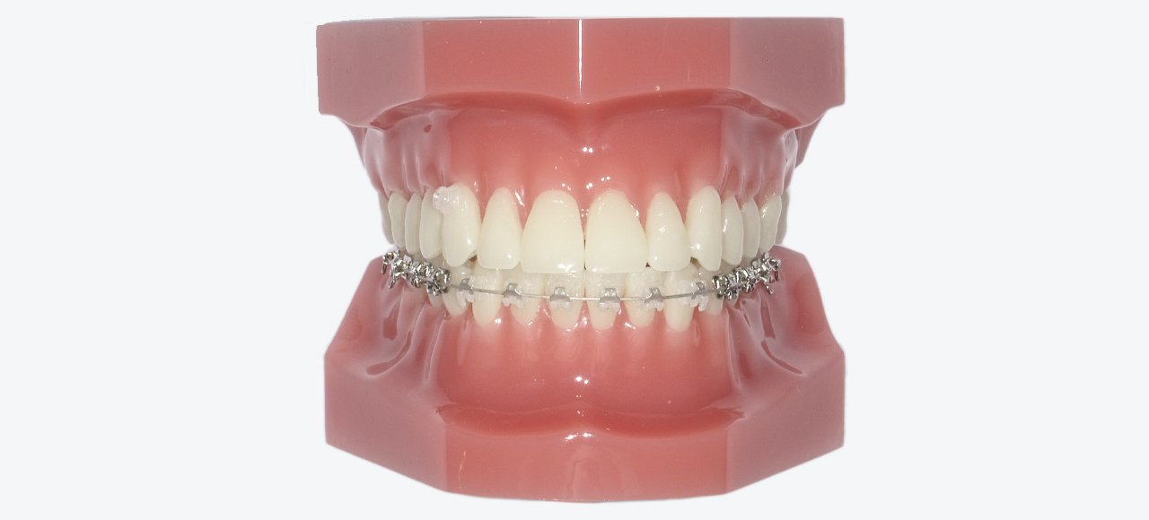 裏側矯正（ハーフリンガル）とは