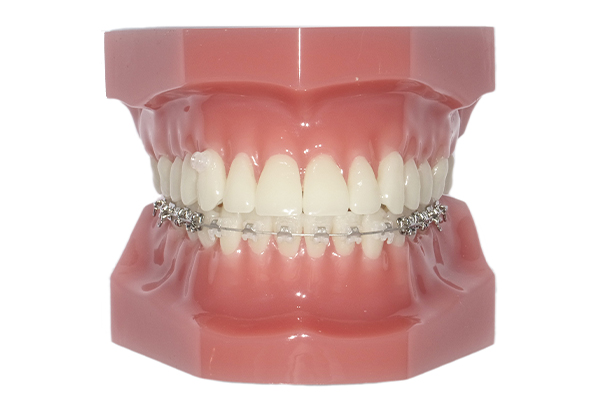 大人の矯正（中学生以降）│川崎市のフォレスタ武蔵小杉矯正歯科