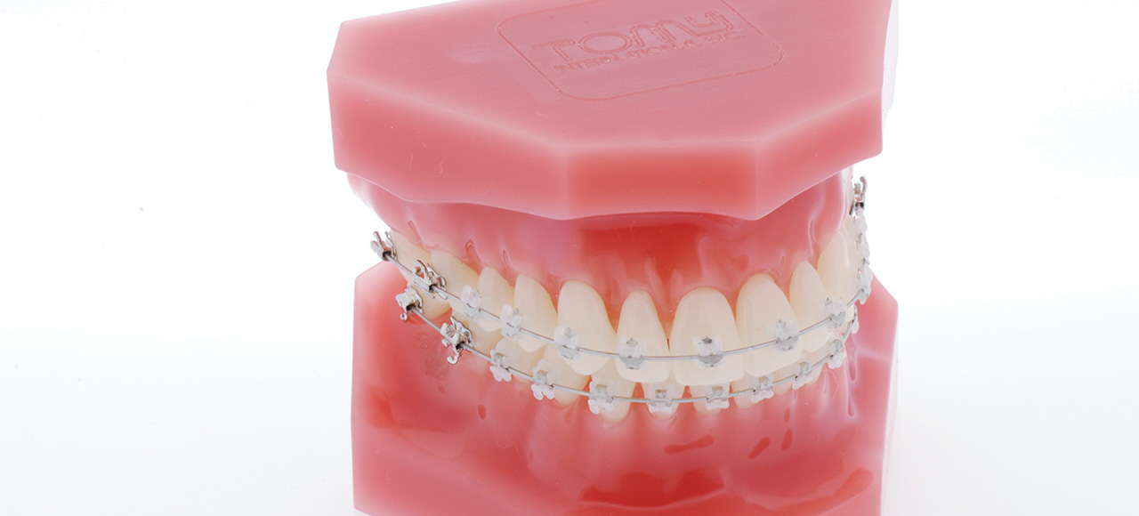 表側矯正（クリアブラケット) とは