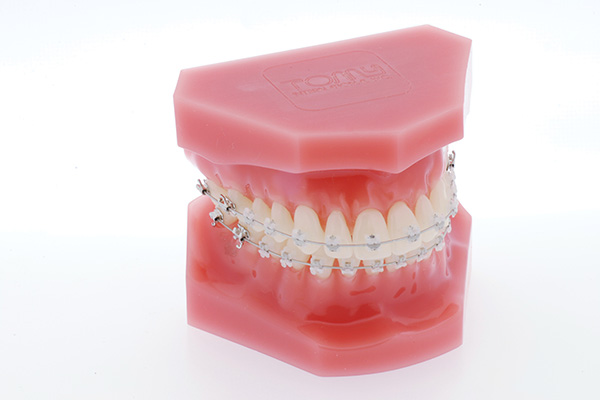 表側矯正（クリアブラケット）